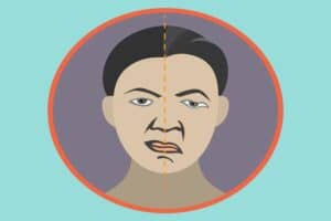 Bell’s palsy and hearing